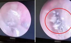 'Sesler duyuyorum' diye doktora gitti! Kulağından 'koloni' çıktı